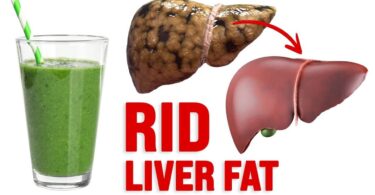 7 Foods To Avoid To Treat Fatty Liver