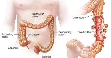 All About Diverticulitis: 9 Home Remedies And Natural Treatments