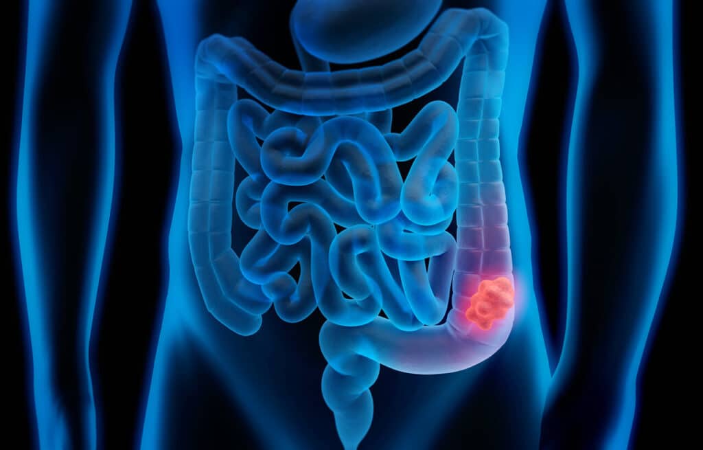 World Cancer Day 2023: Top 4 deadliest cancers in India and their symptoms as per oncologists.