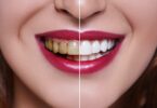 How Long Does Teeth Whitening Last?